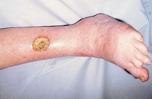 Ulcère variqueux et homéopathie