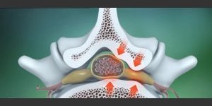 Ostéophytose vertébrale et homéopathie