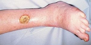 Ulcère variqueux et homéopathie