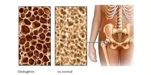 Ostéopénie et homéopathie