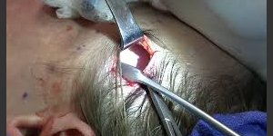 Chirurgie mini-invasive