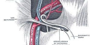Torsion du cordon testiculaire
