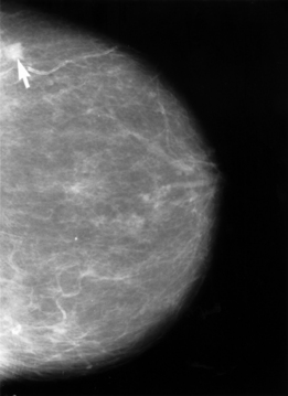 Mammographie