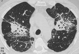 Fibrose pulmonaire