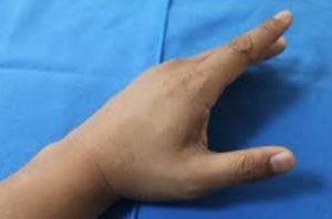 Chirurgie de la main