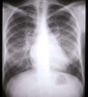 Œdème pulmonaire